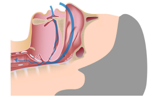 Diagram showing snoring with partial airway obstruction 