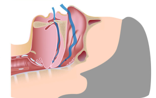 Diagram showing obstructive sleep apnea (OSA) 